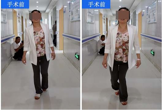 济南关节外科医院不截骨成功治愈先髋高脱 达成患者多年夙愿(图1)