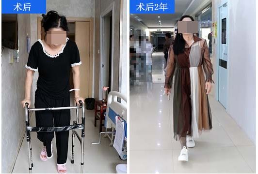 济南关节外科医院不截骨成功治愈先髋高脱 达成患者多年夙愿(图2)