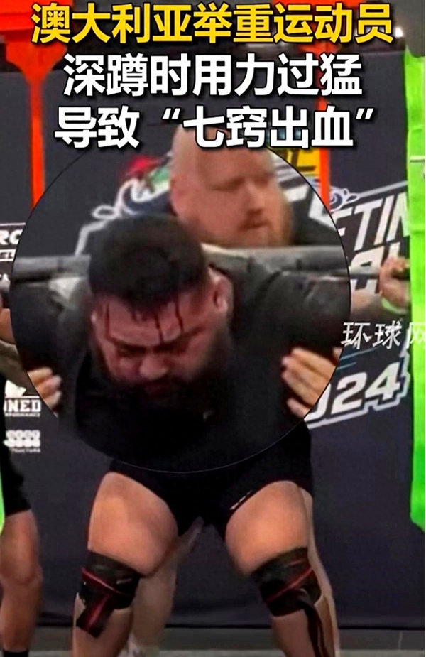 澳大利亚举重运动员举起410公斤杠铃深蹲时七窍出血(图1)